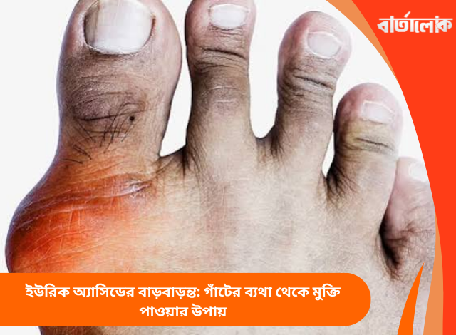 ইউরিক অ্যাসিডের বাড়বাড়ন্ত: গাঁটের ব্যথা থেকে মুক্তি পাওয়ার উপায়